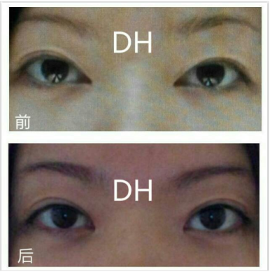 [Eye Surgery, Duhan Plastic Surgery] - [Revision Surgery for a Thick Double-Eyelid Line] image 20