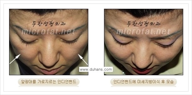 [두한성형외과 경쟁력 미세지방이식] - [귀족수술과 인디언밴드(앞광대주름) 미세지방이식] 관련 이미지 18