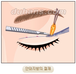눈성형잘하는곳 두한성형외과 - 겹쌍꺼풀 관련 이미지 11