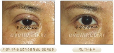 Duhan Plastic Surgery Ophthalmic Reoperation - What Is a Successful Double Eyelid Revision Surgery? image 16
