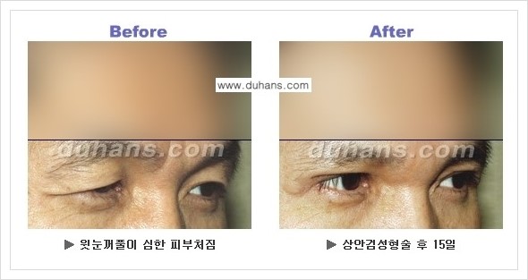 [두한성형외과 경쟁력 눈성형] - [상큼하고 환한 젊은 눈매 상안검성형(윗눈꺼풀 처짐) 안내] 관련 이미지 12