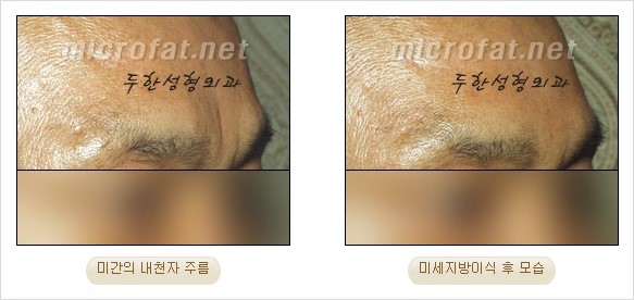 [두한성형외과 경쟁력 지방이식 리더] - [Col-fat(콜펫)지방이식, 3차원 입체지방이식, 2차원 평면지방이식] 관련 이미지 67