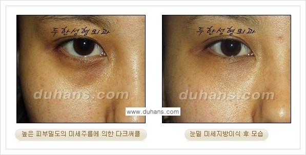 [두한성형외과 경쟁력 눈밑성형] - [꺼진 눈밑, 눈밑 함몰 주름선 눈밑 미세지방이식 안내] 관련 이미지 6