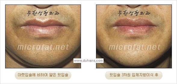 [두한성형외과 경쟁력 미세지방이식] - [입술 3차원 입체지방이식 안내 2.] 관련 이미지 10