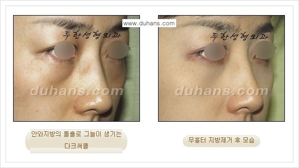 [두한성형외과 경쟁력 안검성형] - [눈밑 지방제거 안내] 관련 이미지 19