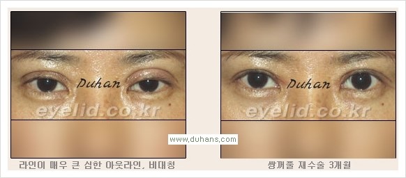 [두한성형외과 경쟁력 눈성형] - [안검하수와 몽고주름에 대한 자주하는 질문과 답변] 관련 이미지 10