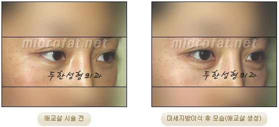 ​[두한성형외과 지방이식] - [애교살] 관련 이미지 10