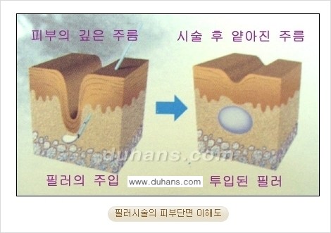 [두한성형외과 젊어지는 주름교정술] - [주름제거 시술방법 ④] 관련 이미지 3