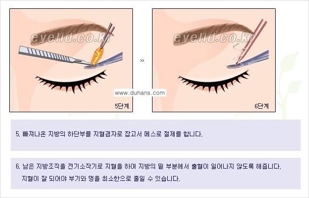 [두한성형외과 경쟁력 눈성형] - [윗눈꺼풀 지방제거 방법 안내] 관련 이미지 5
