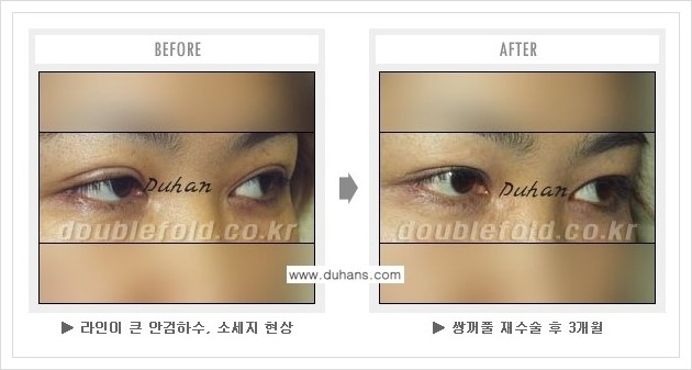 [두한성형외과 경쟁력 쌍꺼풀 재수술, 극한 눈재수술] - [과교정 된 눈매교정] 관련 이미지 3