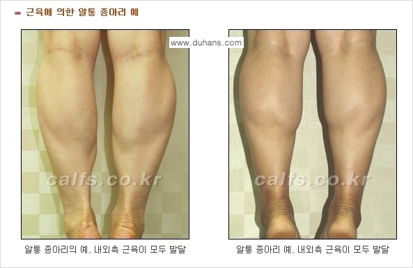 [두한성형외과 경쟁력 멀티종아리성형] - [굵은 알통 종아리 수술 안내 2.] 관련 이미지 3