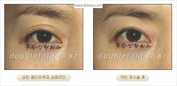 [두한성형외과 경쟁력 눈성형] - [극한 재수술, 함몰된 눈꺼풀 라인교정, 안검하수(졸리운 눈매)] 관련 이미지 30
