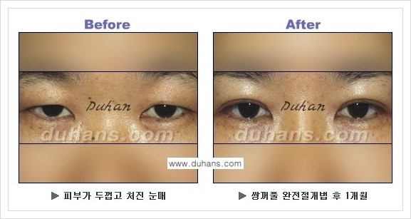 [두한성형외과 경쟁력 눈성형] - [퀵쌍꺼풀 수술 전후 정보 안내 ②] 관련 이미지 3