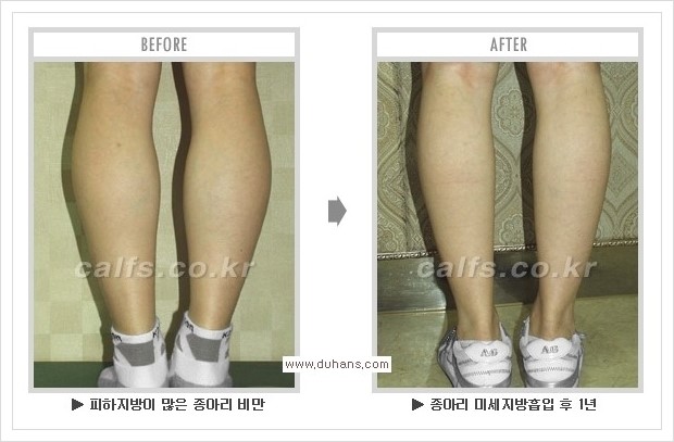 [두한성형외과 경쟁력 멀티종아리성형] - [종아리성형 방법별 전후 주의사항] 관련 이미지 26