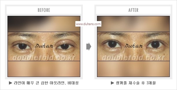 [두한성형외과 경쟁력 눈성형] - [나에게 맞는 어울리는 쌍꺼풀 라인] 관련 이미지 16