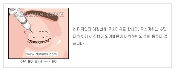 [두한성형외과 경쟁력 안검성형] - [상큼하고 환한 눈매의 완성 상안검 성형술 안내] 관련 이미지 2
