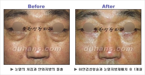 [두한성형외과 경쟁력 동안성형 리더] - ​[미간주름, 이마주름, 안검성형, 이마거상술, 눈썹거상술] 관련 이미지 87