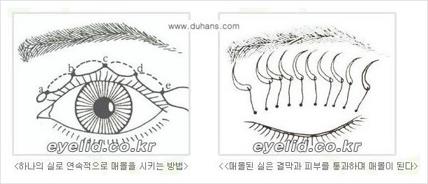 [두한성형외과 경쟁력 맞춤 눈성형] - [매몰법, 절개법의 수술 방법] 관련 이미지 3