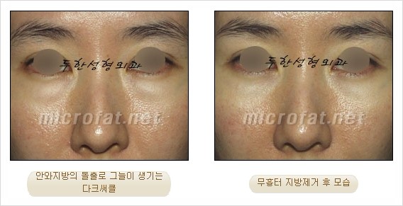 [두한성형외과 쌍커풀수술] - [눈성형 방법에 대한 자주하는 질문과 답변] 관련 이미지 176