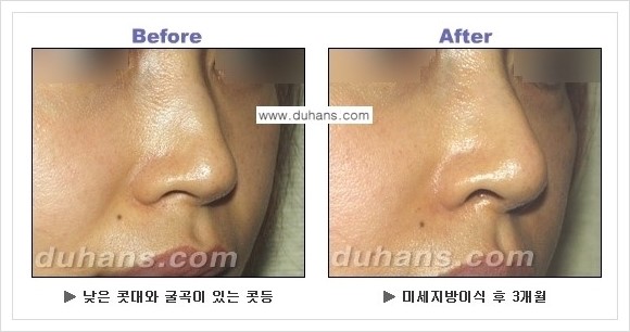 [두한성형외과 경쟁력 코성형] - [코높힘 미세지방이식 정보 안내] 관련 이미지 12