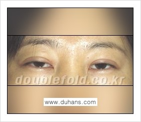 [두한성형외과] - [쌍꺼풀 재수술의 대상과 그에 대한 쌍꺼풀 재수술 방법 안내] 관련 이미지 7