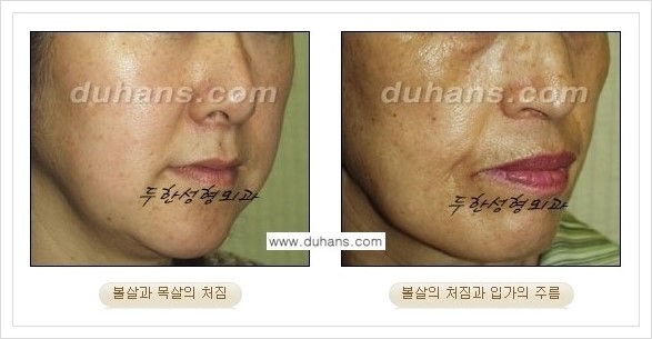 [두한성형외과 경쟁력 주름성형] - [엔도타인 리프팅 안내 ①] 관련 이미지 2