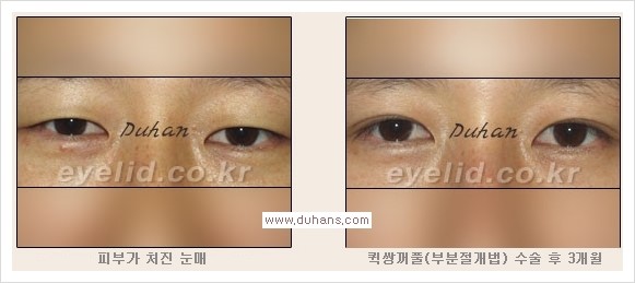 [두한성형외과 경쟁력 눈성형] - [퀵쌍꺼풀(부분절개법) 안내] 관련 이미지 12