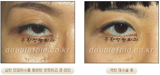 [DoubleFold Plastic Surgery Eye Surgery] - [Revision Surgery for Thick Double Eyelids] image 47