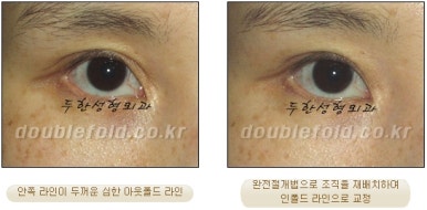 [Duhan Plastic Surgery Double Eyelid Revision] - [Reducing the Double Eyelid Line] image 34
