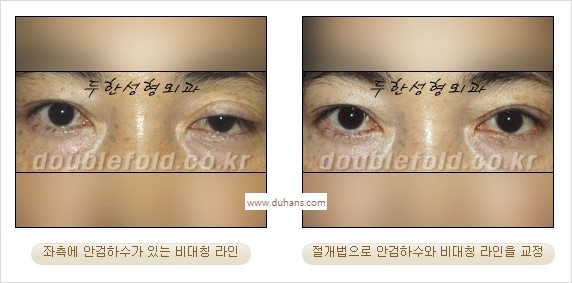 ⁠⁠[두한성형외과 경﻿쟁력 쌍꺼풀 재수술] - [안검하수(졸리운 눈매) 종류와 교정 방법 안내] 관련 이미지 21