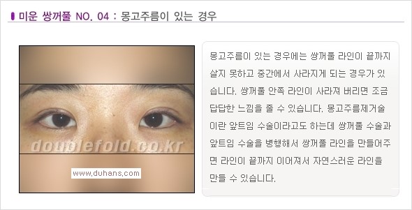 [두한성형외과 경쟁력 눈성형] - [나에게 맞는 맞춤 쌍꺼풀 찾기] 관련 이미지 4