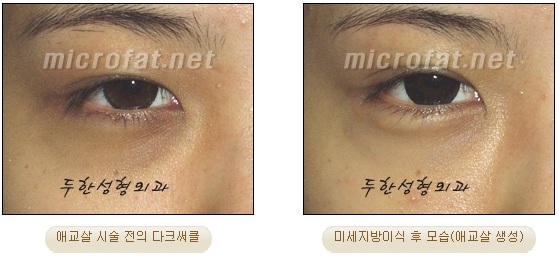 Duhan Plastic Surgery Under-Eye Surgery - Correction with Fat Grafting After Aegyo-Sal Filler image 22