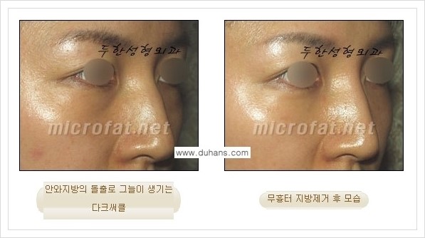 [두한성형외과 경쟁력 눈밑성형] - [눈밑지방제거, 눈위지방제거 안내 2.] 관련 이미지 5
