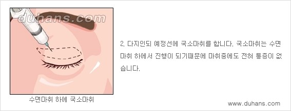 [두한성형외과 성형 FOCUS] - [젊고 환한 눈매 상안검성형 안내] 관련 이미지 3