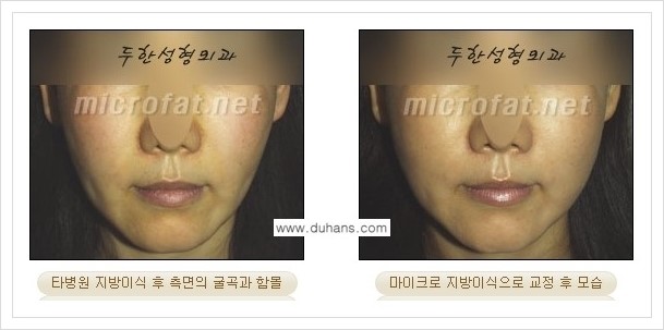 [두한성형외과 경쟁력 윤곽성형] - [볼, 볼살 지방이식] 관련 이미지 38