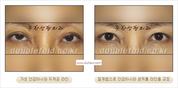 ⁠⁠[두한성형외과 경﻿쟁력 쌍꺼풀 재수술] - [안검하수(졸리운 눈매) 종류와 교정 방법 안내] 관련 이미지 22