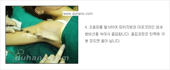 [두한성형외과 성형 FOCUS 지방흡입] - [액취증 - 다한증 초음파 컷터 지방흡입 ③] 관련 이미지 11