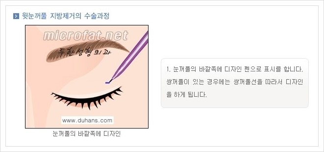 [두한성형외과 경쟁력 지방제거] - [눈 지방제거 안내] 관련 이미지 3