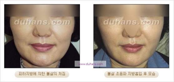 [두한성형외과 경쟁력 지방흡입] - [볼살, 턱선의 간편 지방흡입] 관련 이미지 18