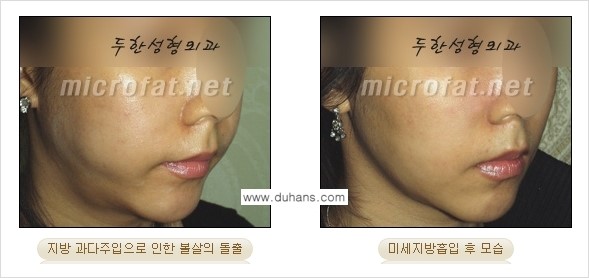 [두한성형외과 경쟁력 미세지방이식] - [미세지방이식 부작용 종류와 교정방법 안내] 관련 이미지 9