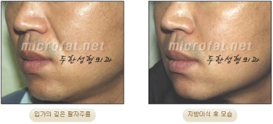 [Duhan Plastic Surgery Face Fat Grafting] - [Reducing Mouth Corners Wrinkles and Nasolabial Folds] image 7