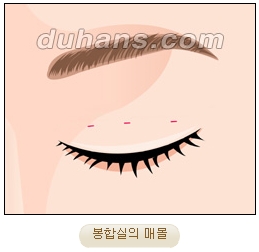 눈성형잘하는곳 두한성형외과 - 겹쌍꺼풀 관련 이미지 14