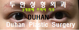 [DuHan Plastic Surgery Double Eyelid Surgery] - [Frequently Asked Questions and Answers About Eye Plastic Surgery] image 17