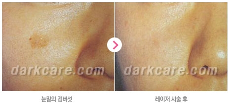 [두한성형외과 콤비프로그램] - [다크서클 + 검버섯 레이저] 관련 이미지 10