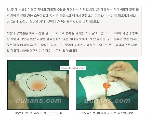 [두한성형외과 경쟁력 미세지방이식] - [부드럽고 아름다운 얼굴선 얼굴 미세지방이식 과정] 관련 이미지 6