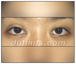 Candidates for Double Eyelid Revision Surgery: Unattractive Double Eyelids, Beautiful Double Eyelids image 8