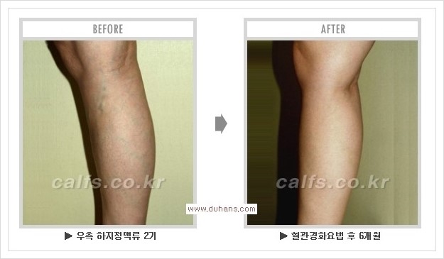 [두한성형외과 경쟁력 멀티종아리성형] - [종아리성형 방법별 전후 주의사항] 관련 이미지 33