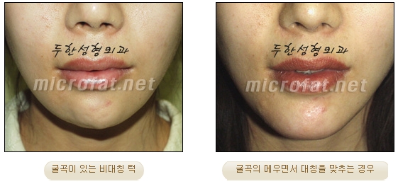 [두한성형외과 미세지방이식] - [무턱교정 안내] 관련 이미지 5