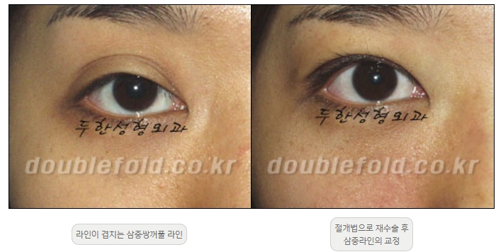 [Double Eyelid Surgery Duhan Plastic Surgery] - [Revision Methods] image 23