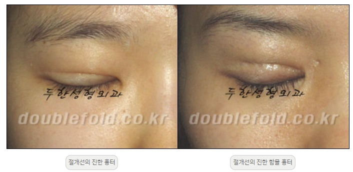 [Double Eyelid Surgery Duhan Plastic Surgery] - [Revision Methods] image 38